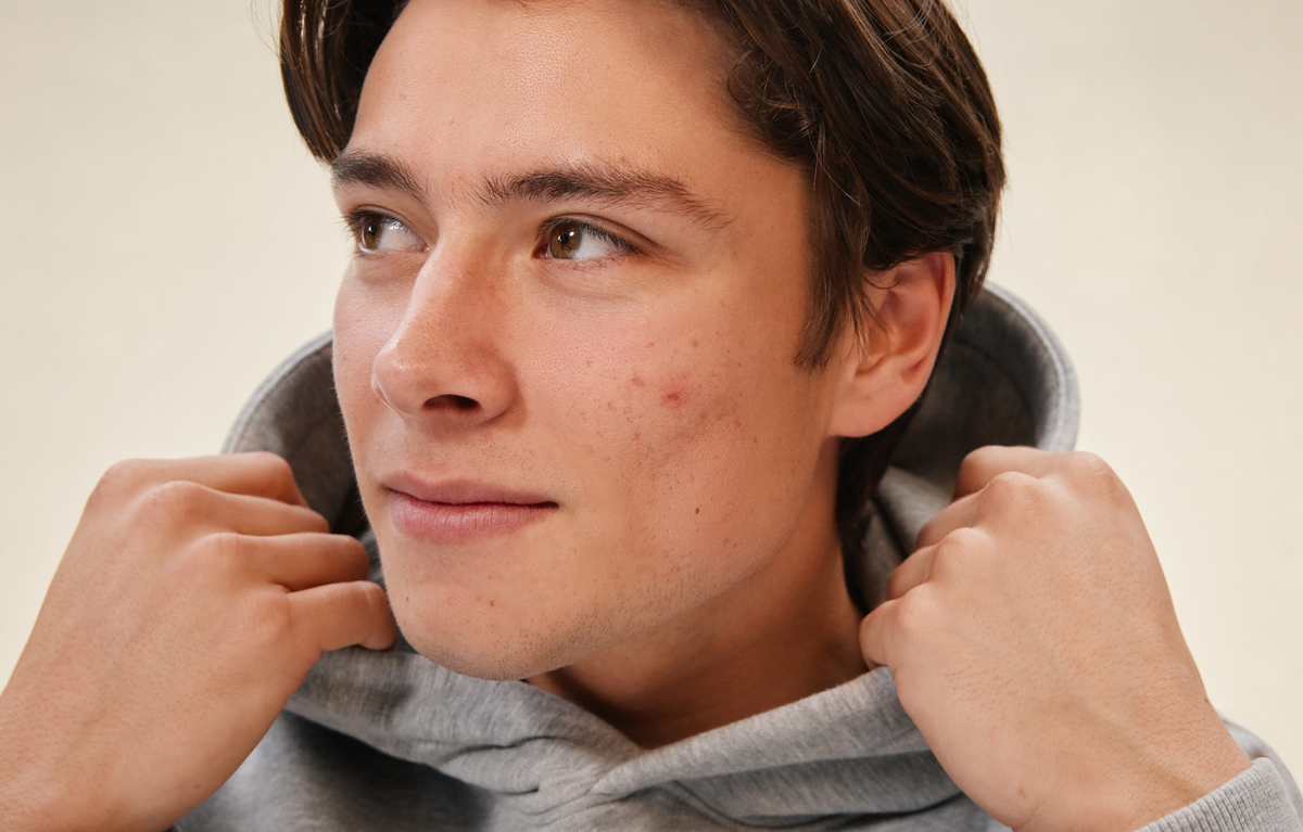 Derm Guide to Fighting Acne: How to Beat It by Dr. Asempa