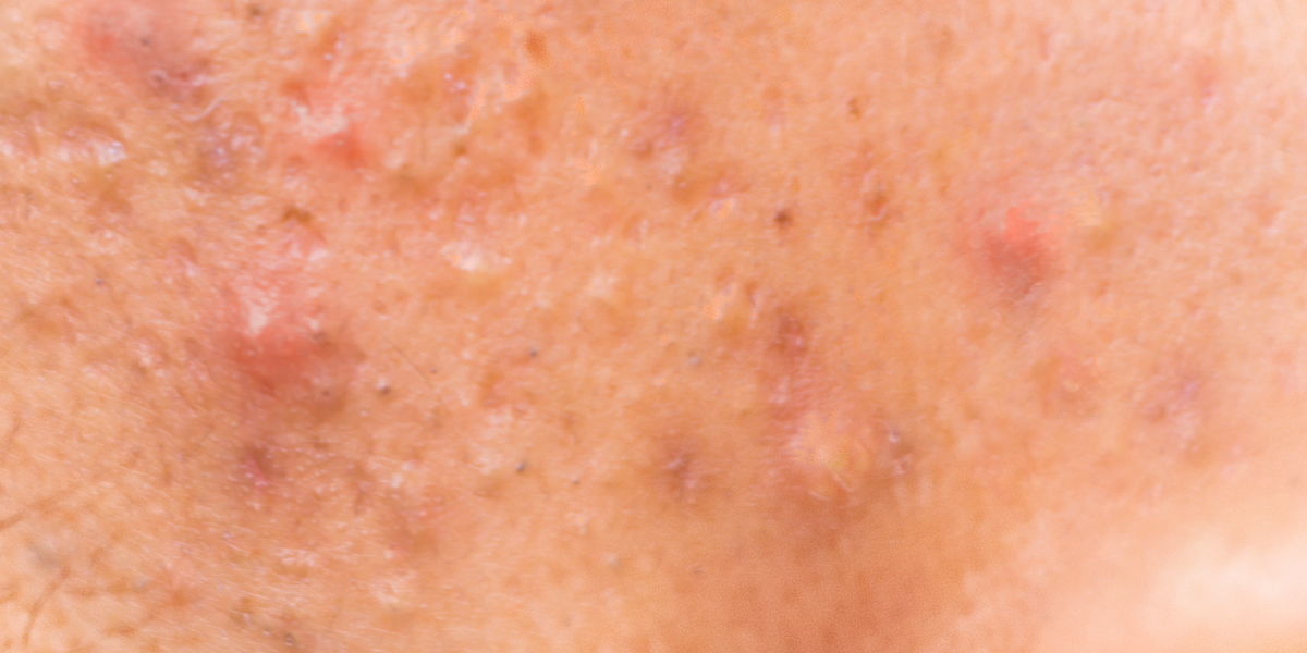 Close-up of skin with visible pores and texture
