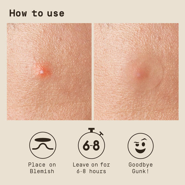 Instructions on how to use a acne fighting care product with before and after images of blemish removal for PAPATUI Pimple patches for men.