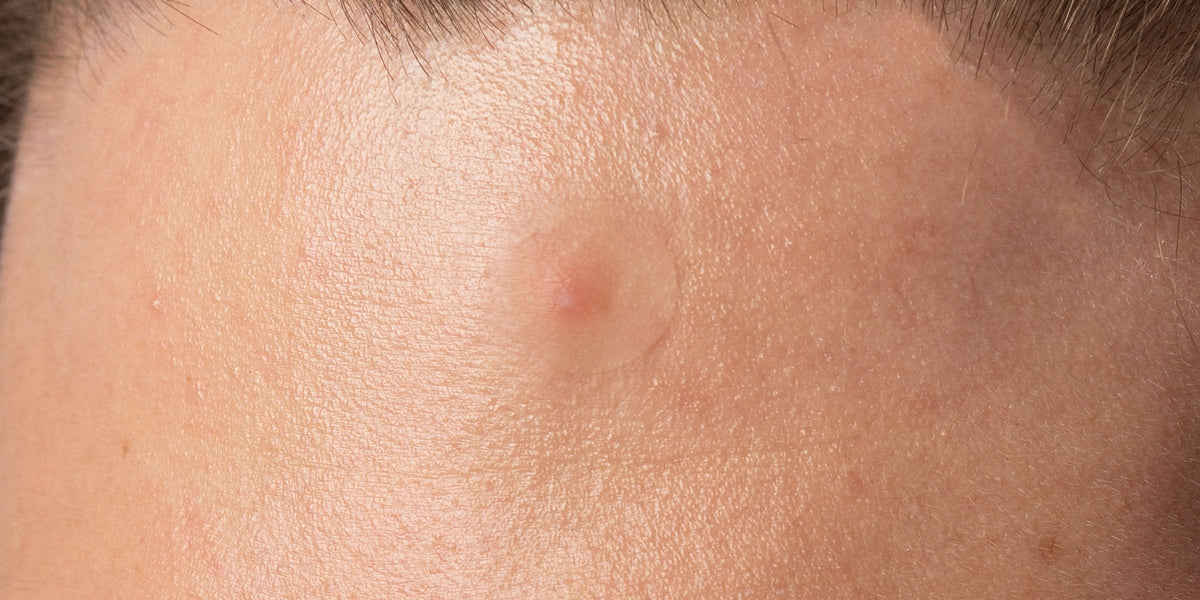 Close-up of a  PAPATUI Pimple Patch on skin blemish on a person's face