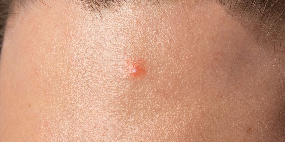 Close-up of a small red bump on skin